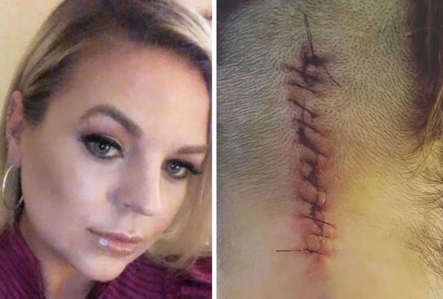Atriz Kirsten Storms mostra cicatriz na cabeça (Foto: Reprodução/Instagram)