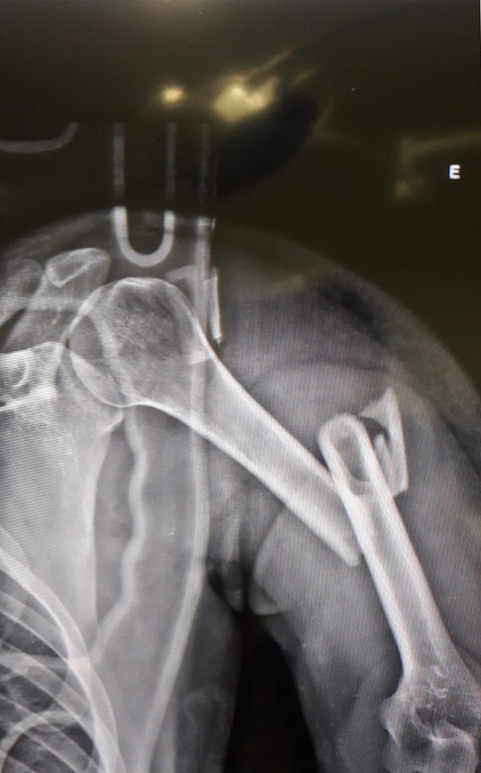 Ciclista fraturou o osso do braço e vai ter de passar por cirurgia — Foto: Luís Ricardo Castanha Atencia