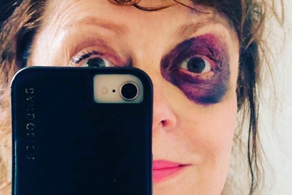 A atriz Susan Sarandon com os olhos roxos após queda (Foto: Instagram)