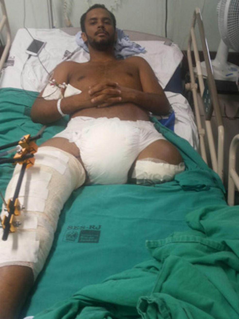 Vitor teve a perna amputada e perdeu parte do pulmão ao ser atingido por tiros disparados por um cabo do Exército na Salsa e Merengue, em 2015 (Foto: Divulgação/Arquivo Pessoal)