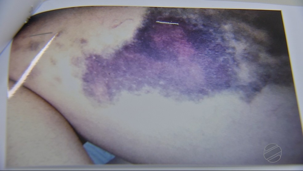 Foto mostra hematomas que a mulher sofreu agredida pelo ex-marido delegado em Mato Grosso (Foto: TV Centro América)
