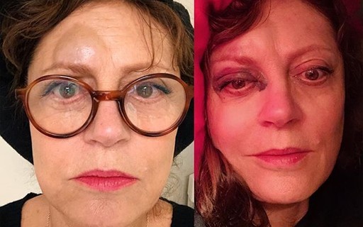 Susan Sarandon mostra hematomas no rosto após queda