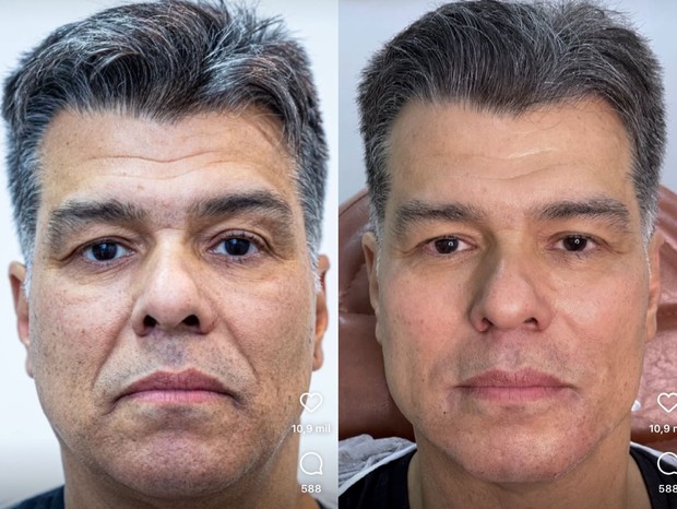 Antes e depois de harmonização facial de Maurício Mattar (Foto: Reprodução/Instagram)