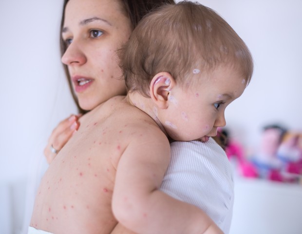 Sarampo: por que doenças consideradas erradicadas estão voltando? (Foto: Getty Images)