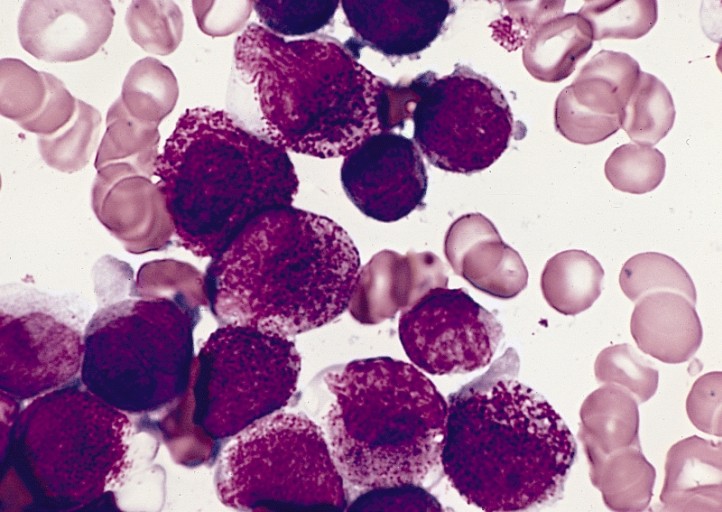  Glóbulos brancos com leucemia: pesquisa pode indicar novos rumos para tratamento da doença   (Foto: Wikimedia Commons)