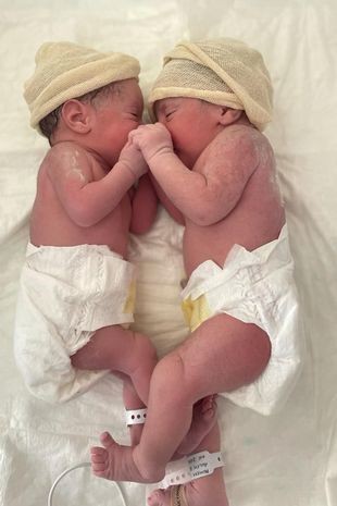 Segunda gêmea nasceu empelicada (Foto: Reprodução/Mirror)