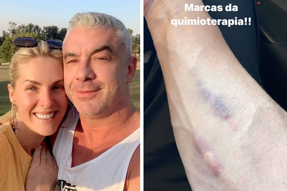 Alexandre Correa, marido de Ana Hickmann, exibe roxos no braço (Foto: Reprodução/Instagram)