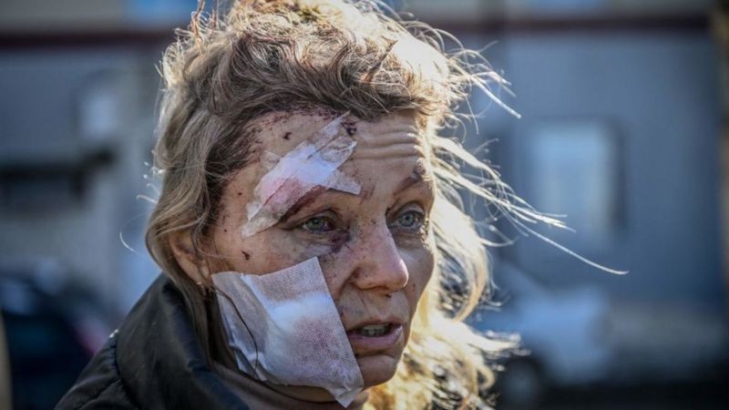 Uma mulher ferida por bombardeios russos tornou-se objeto de teorias da conspiração e falsas alegações nas redes sociais (Foto: Getty Images via BBC News)