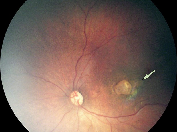  Exame de imagem mostra um caso de atrofia macular grave em bebê com microcefalia  (Foto: The Lancet/Divulgação)