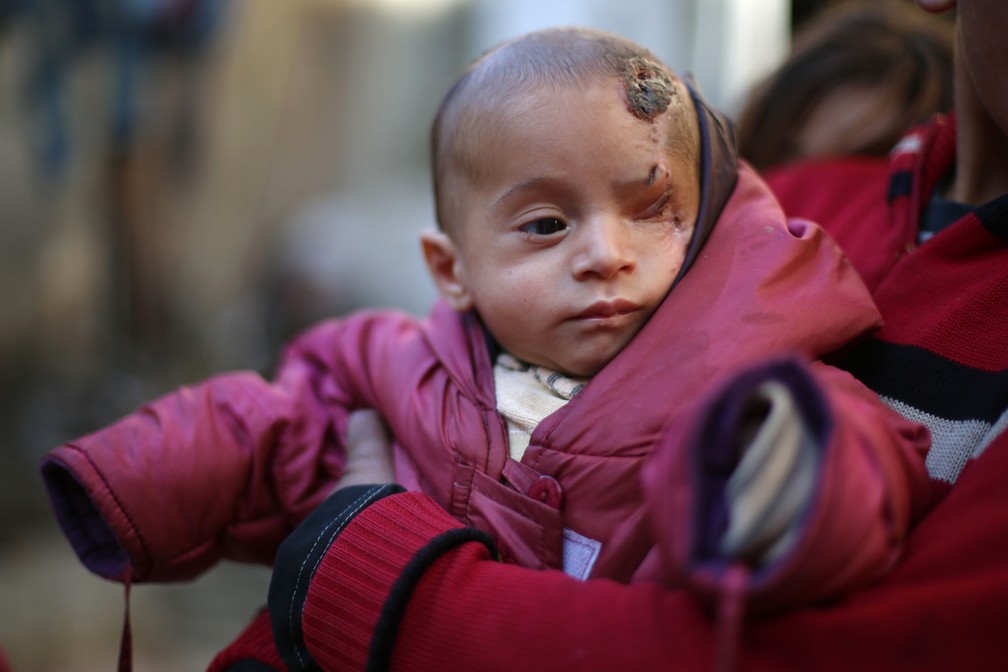 Foto tirada em 4 de dezembro mostra bebê sírio Karim Abdallah, que perdeu um dos olhos e sua mãe em um bombardeio em Hamuria (Foto: AFP Photo/Handout/#SolidarityWithKarim)