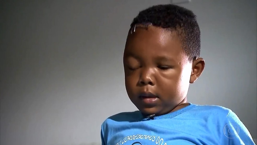 Rian Santos de 8 anos, se recupera de grave lesão no olho. (Foto: Reprodução/ TV Bahia)