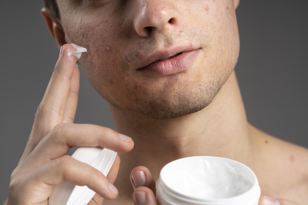 Tratamento de uso tópico (em cremes e pomadas) é prescrito para acnes de grau 1 e 2 — Foto: Reprodução/Pexels