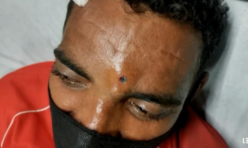 Discussão em Juazeiro deixou homem baleado com tiro de chumbinho na testa. — Foto: Divulgação