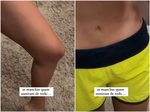 17 de junho de 2022: Letícia Santiago mostra recuperação de inflamação na pele (Foto: Juliana Figueroa e Reprodução/Instagram)