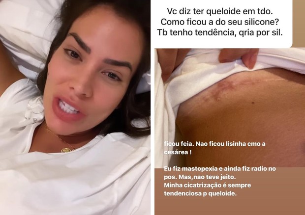 Adriana Sant‘Anna mostra cicatrizes que tem no corpo (Foto: Reprodução/Instagram)