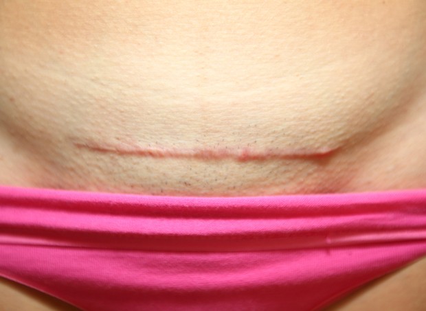 cicatriz de cesárea (Foto: ThinkStock)