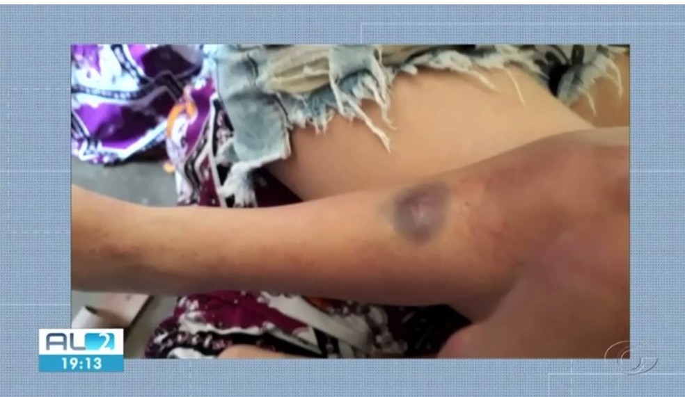 Foto por família mostram marcas de agressão em corpo de menina de 4 anos em Arapiraca, AL — Foto: Reprodução/TV Gazeta