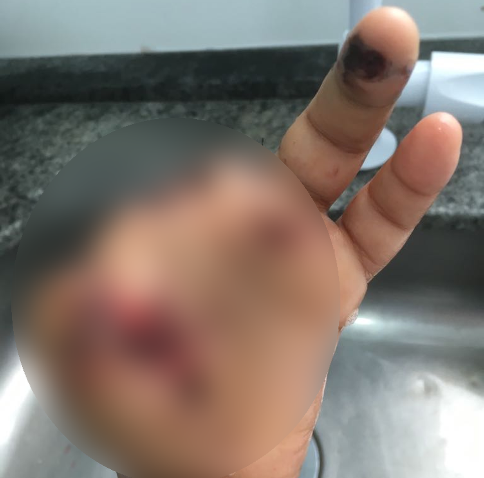 Trs dedos foram amputados aps exploso de bombinha (Foto: Arquivo pessoal)