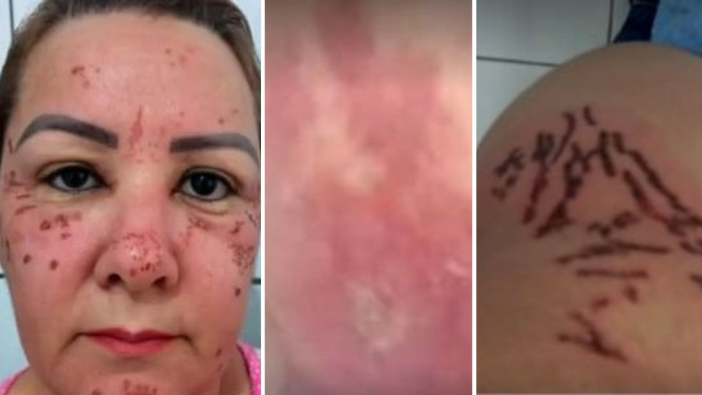 Polícia investiga esteticista denunciada por clientes que tiveram sequelas após sessões em Mairinque — Foto: Reprodução/ TV TEM 