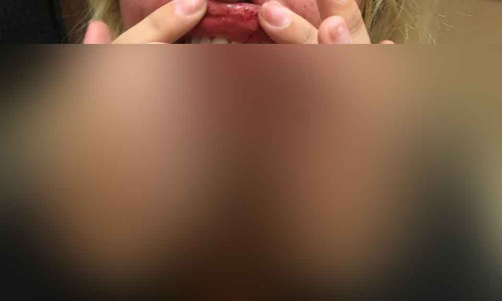 Agredida por Vanderlei Bambam mostra lesão na boca  — Foto: Reprodução