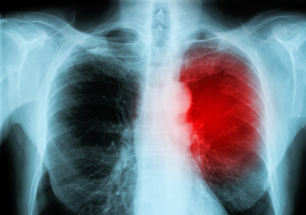 Coronavirus Causa Miocardite Inflamacao No Musculo Do Coracao Saude Ge