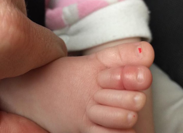 Síndrome do torniquete de cabelo: o dedo da pequena Molly, 45 minutos depois de ter sido salva pela mãe (Foto: Reprodução/ Facebook)