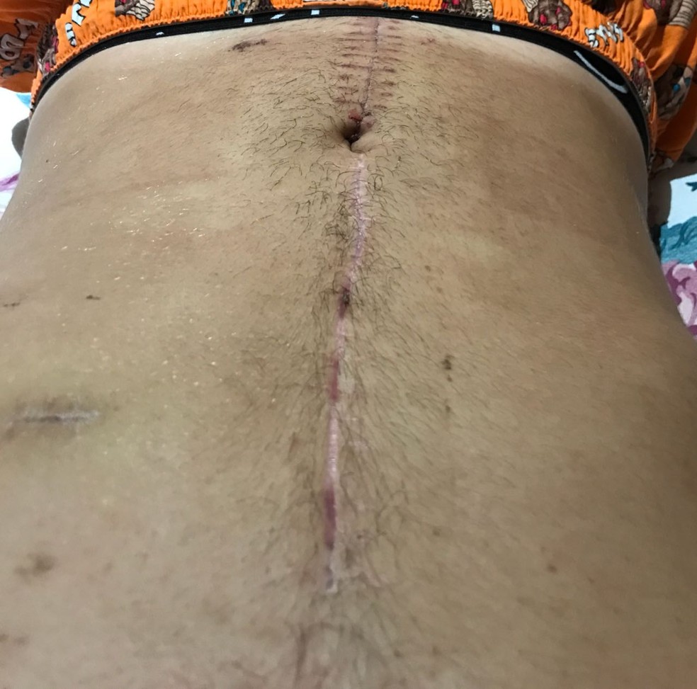 Depois de tirar os pontos da cirurgia, Gabriel ainda ficou duas semanas em repouso (Foto: Gabriel Pincano/Arquivo Pessoal)