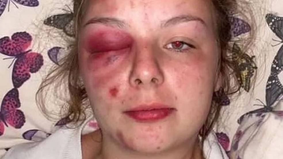 No julgamento, concluiu-se que Eleanor Williams causou em si mesma ferimentos usando um martelo.  — Foto: Reprodução via BBC