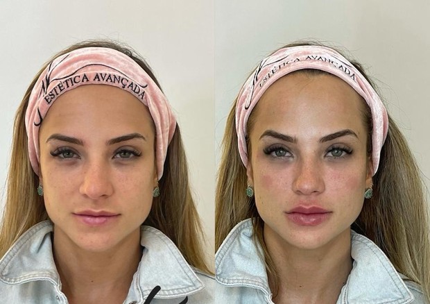 Gabi Martins retoca botox e preenchimento e mostra resultado na web (Foto: Reprodução/ Instagram)