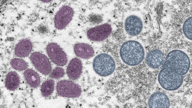 RS passa de 200 casos suspeitos de varíola dos macacos; outros 47 estão confirmados