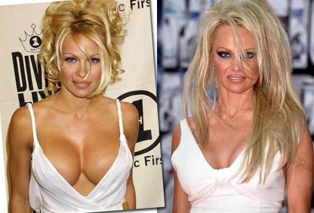 Pamela Anderson, que ficou famosa pelos seios fartos, também optou pela troca dos silicones (Foto: Getty Images)