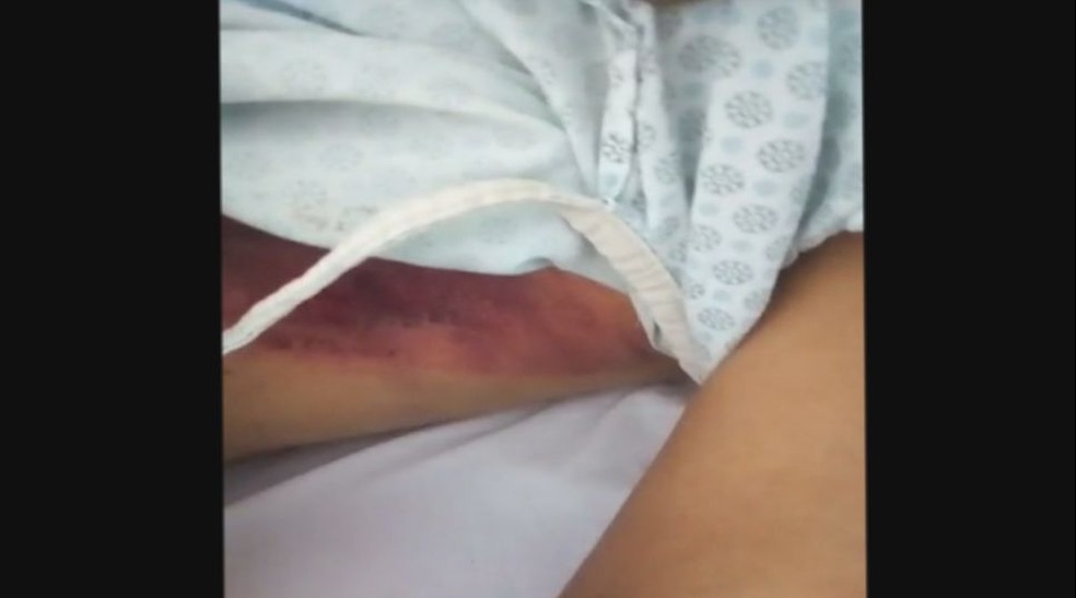Vítima, de 55 anos, teve cinco costelas fraturadas e vários ferimentos pelo corpo por conta do ataque (Foto: Reprodução/TV TEM)