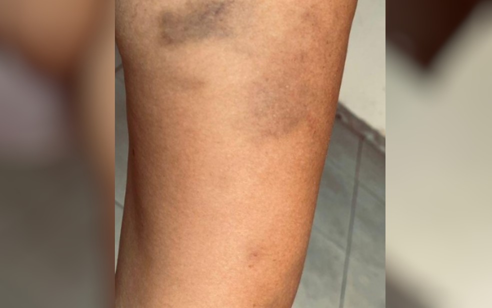 Estudante ficou com hematoma no braço após agressão, em Trindade, Goiás — Foto: Reprodução/arquivo pessoal