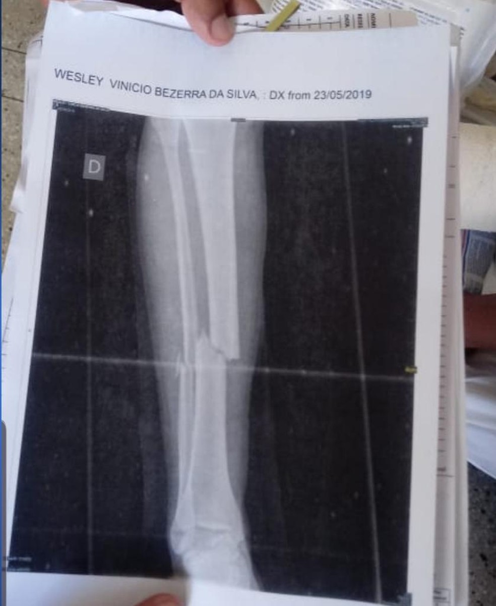 Veterano fraturou dois ossos da perna direita — Foto: Reprodução