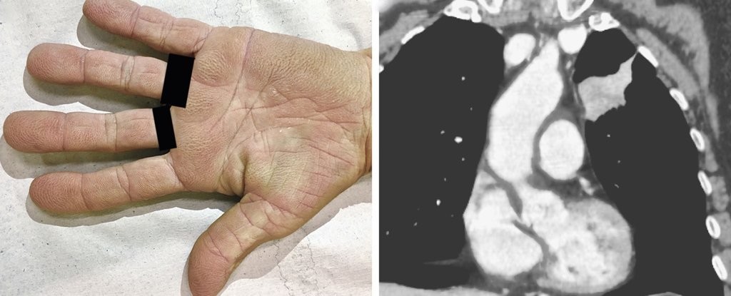 O sinal oculto do câncer de pulmão que pode ser visto nos dedos