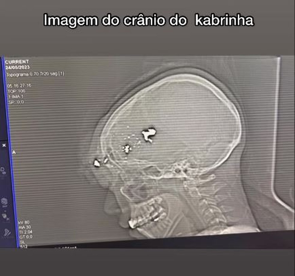 Fam&iacute;lia do influenciador compartilhou raio-X &mdash; Foto: Reprod&ccedil;&atilde;o/Instagram