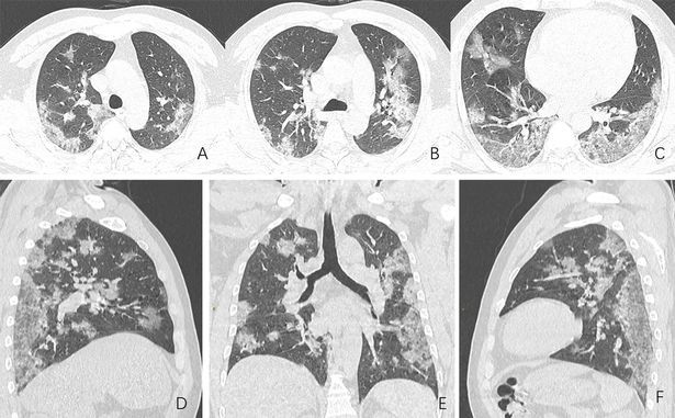 Pulmões de um chinês de 44 anos que morreu por conta da doença (Foto: Radiological Society of North America (RSNA))