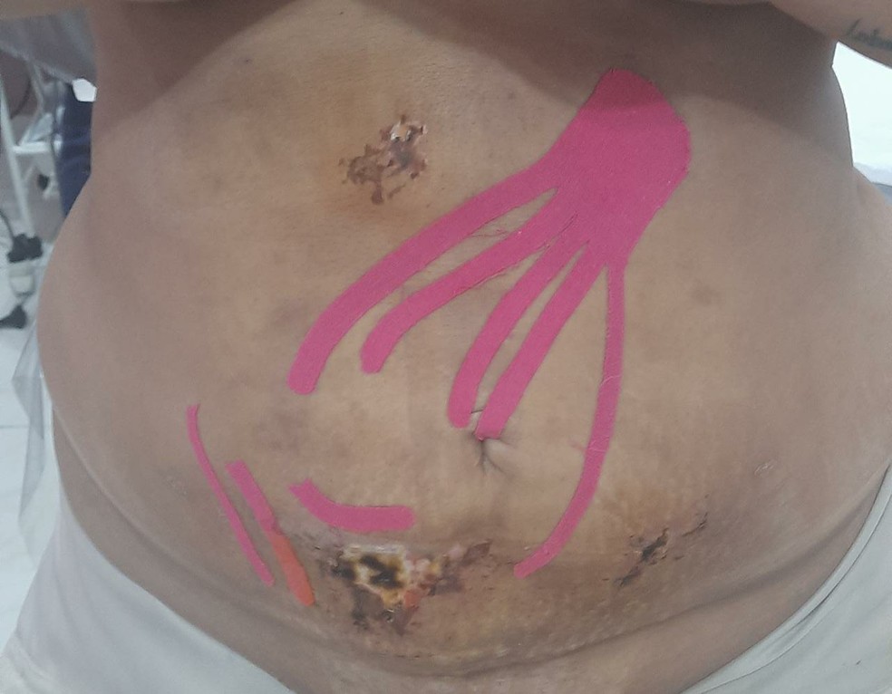 Paciente tirou fotos que mostram as queimaduras após o procedimento — Foto: Arquivo pessoal