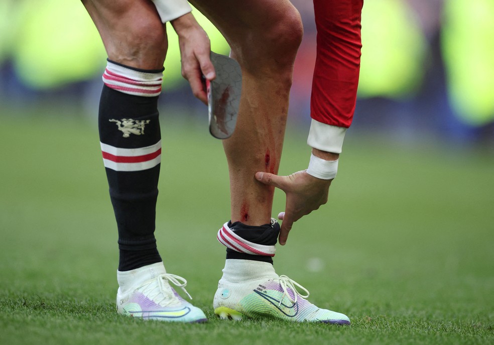 Cristiano Ronaldo mostra a canela sangrando após a derrota do Manchester United para o Everton — Foto: Phil Noble/Reuters