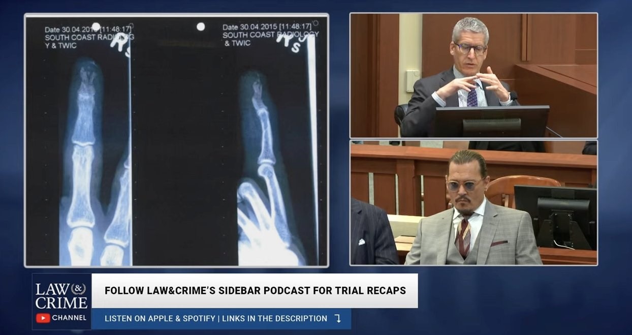 Radiografia de dedo da mão de Johnny Depp é mostrada durante julgamento (Foto: Law e Crime Channel/Youtube)