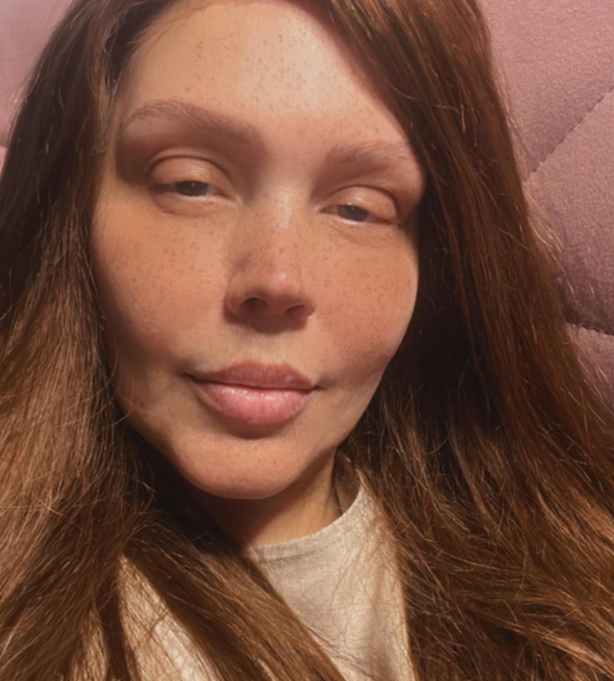 Simony posta foto após tratamento