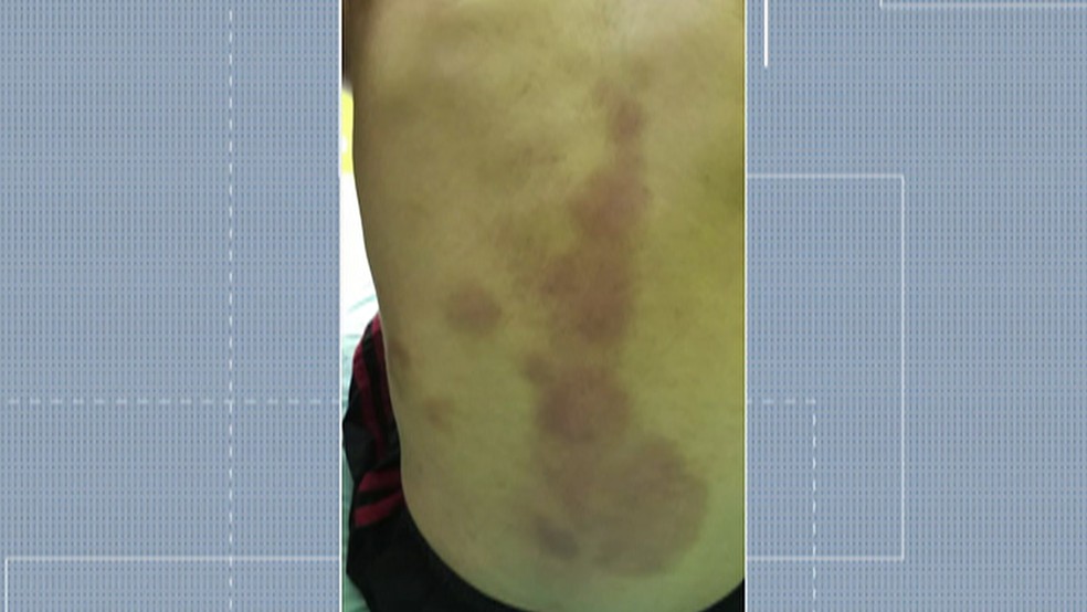 Costas de criança ficou com marcas da agressão sofrida pelo padrasto em Santa Isabel.  — Foto: Reprodução/TV Diário