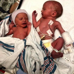 Os gêmeos, Blakeley e Cade, logo após o nascimento (Foto: SWNS)