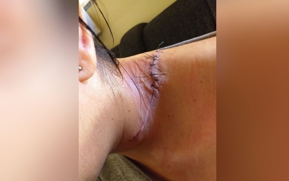 Mulher quase morre ao ter pescoço cortado por linha de cerol, em Goiânia. — Foto: Reprodução TV Anhanguera