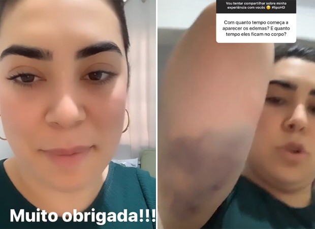 Naiara Azevedo agradece preocupação dos fãs com recuperação e mostra hematomas no braço (Foto: Reprodução/Instagram)