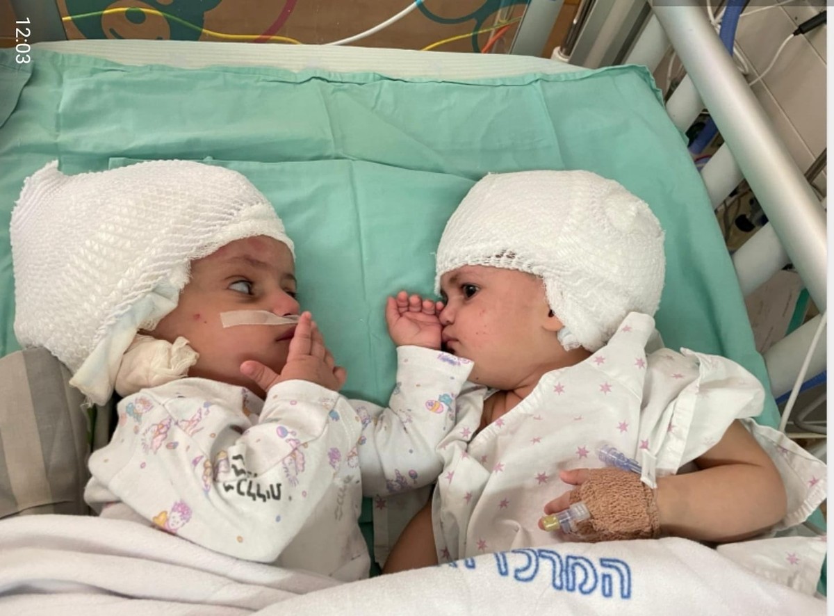 Gêmeas siamesas que nasceram unidas pela parte de trás da cabeça em Israel conseguem finalmente se ver após cirurgia