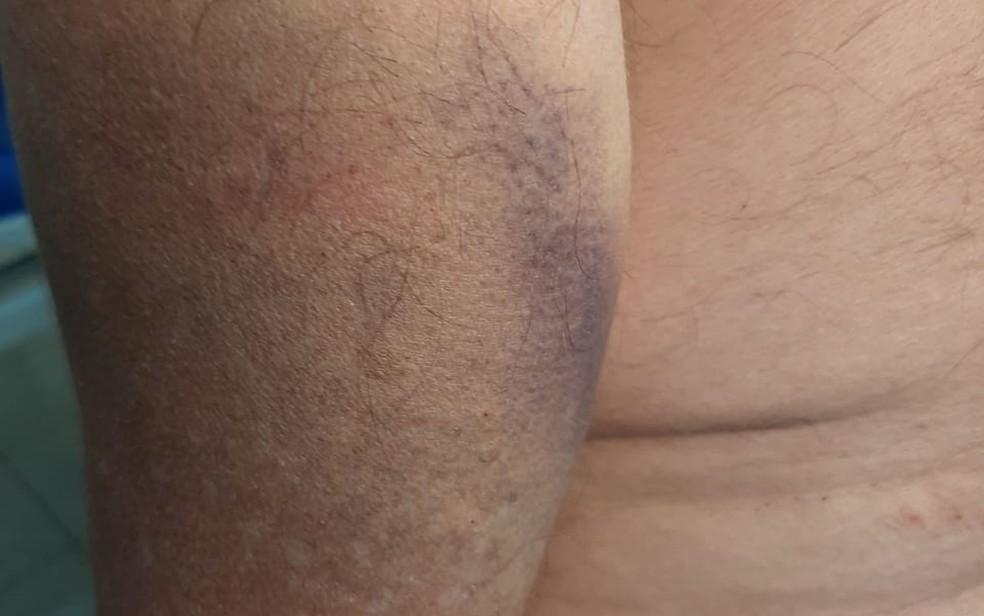 Hematoma no braço de idoso que fugiu de clínica de reabilitação em Sales Oliveira, SP  — Foto: Polícia Civil/Divulgação