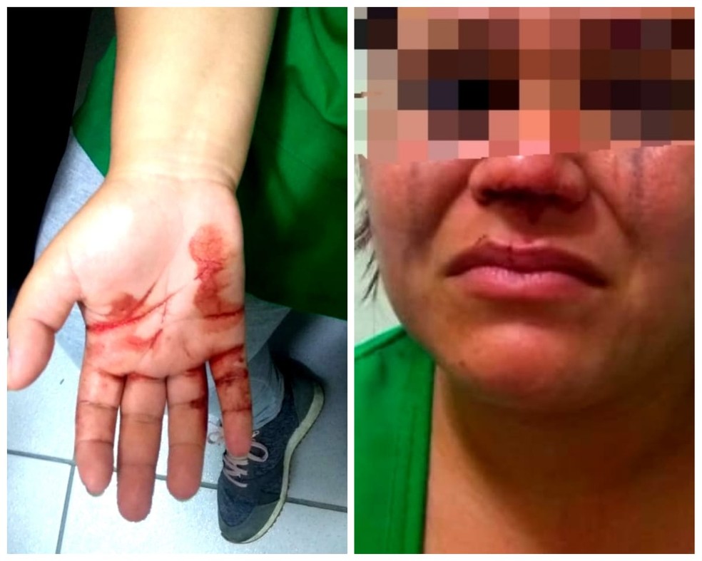 VÃ­tima ficou com ferimentos na mÃ£o e no nariz â€” Foto: G1 Santos