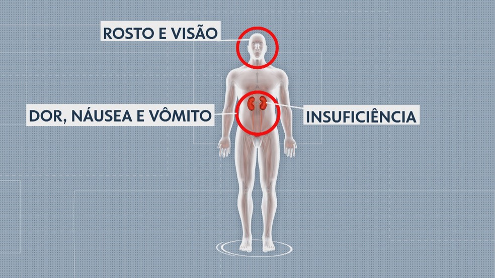 Ministério da Saúde investiga síndrome nefro neural em Minas Gerais  — Foto: Reprodução/TV Globo 