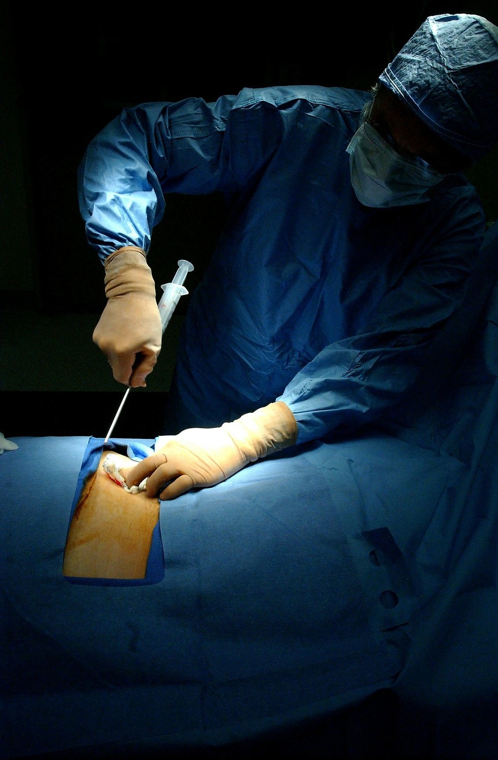 surgery 85574 1920 - Novo material pode substituir transplante de medula óssea, diz estudo